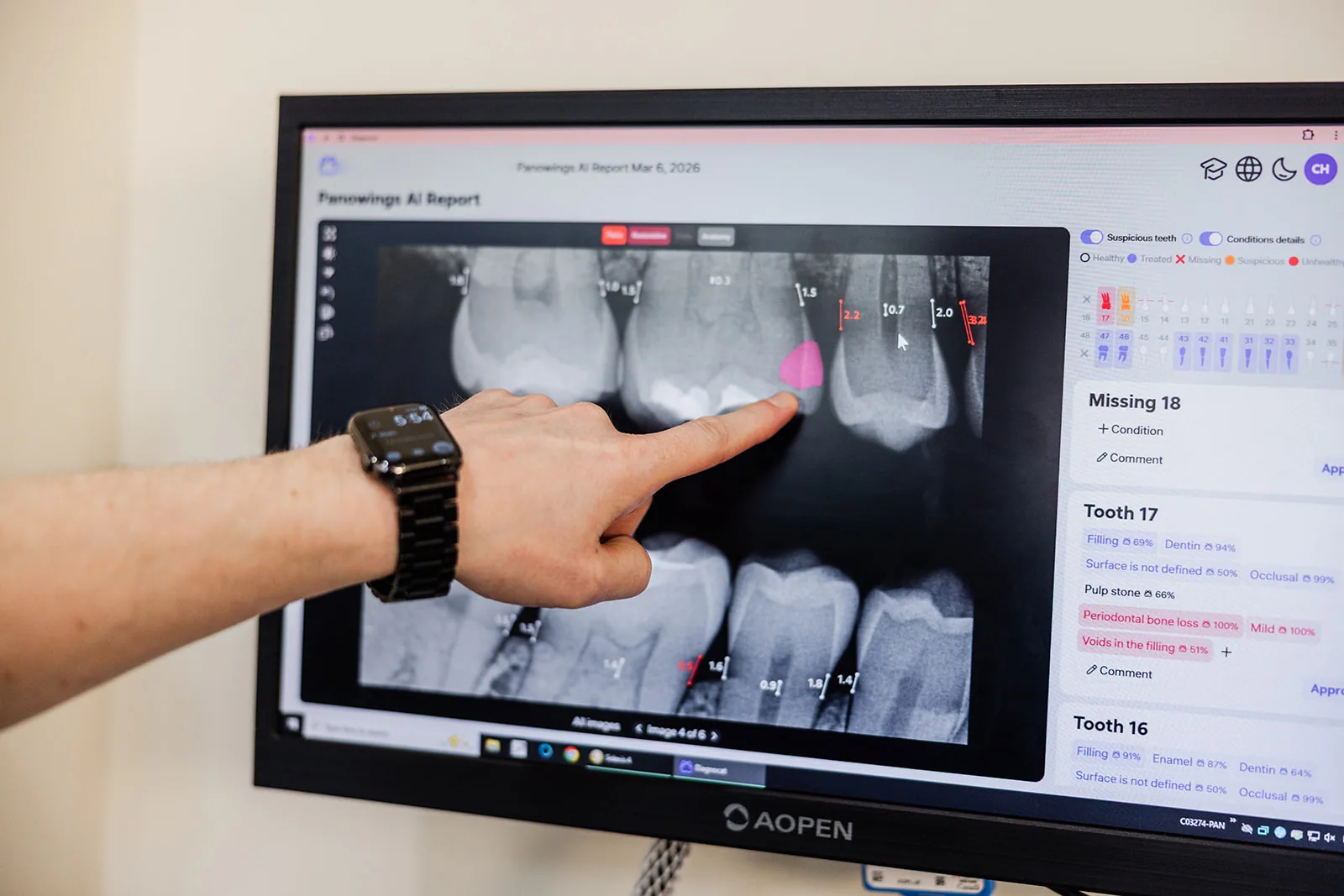 A dental x-ray displayed on screen during diagnosis